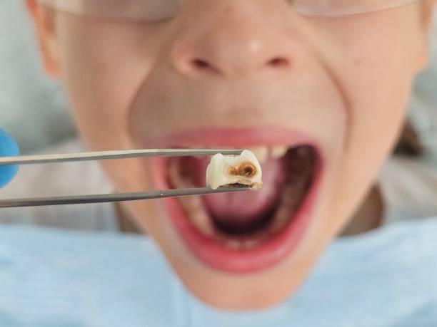 Best Emergency Treatment for Dental Infections or Abscesses in Melville, NY