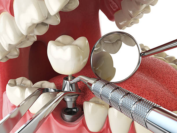Best Emergency Tooth Extraction in Melville, NY